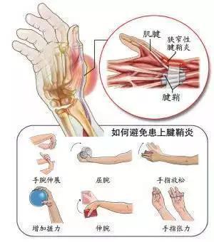伸开五指再并拢,双手互相揉捏,旋转手腕等方式都可以有效预防腱鞘炎